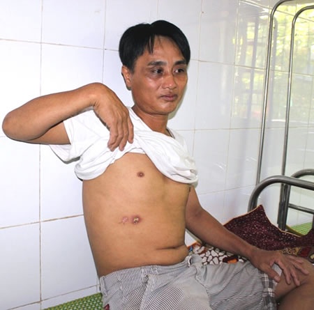 Vết thương nơi mạn sườn anh Khánh do Như chích điện.