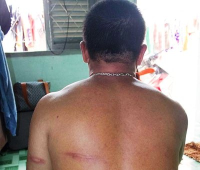Anh Ngư bị nhóm thanh niên đánh gây thương tích nhiều chỗ ở đầu và lưng.