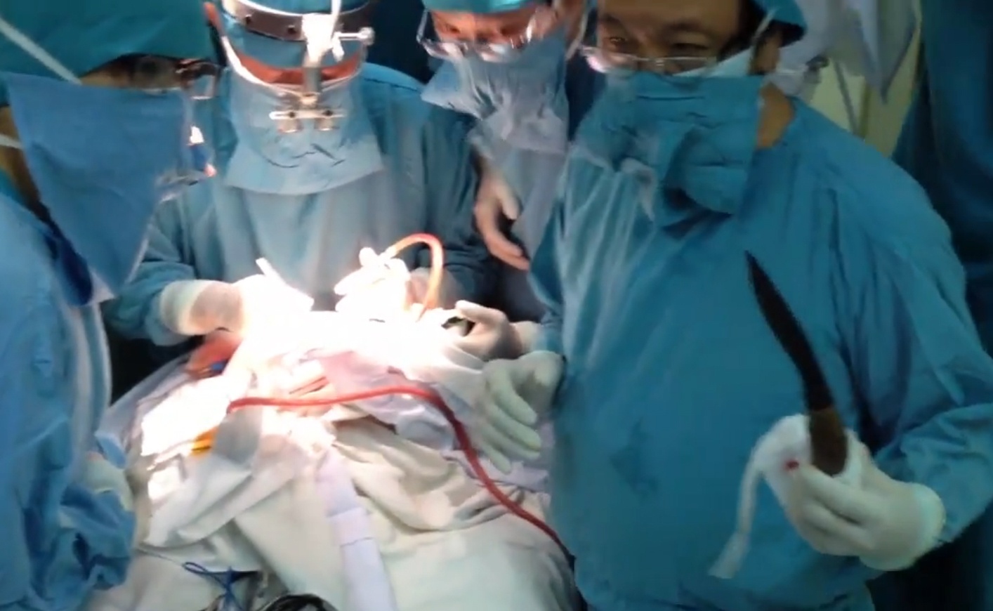 Bac si ke phut nghet tho rut dao khoi dau be so sinh hinh anh