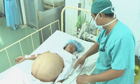 Hut hon 12 lit dich trong khoi u o bung benh nhan hinh anh