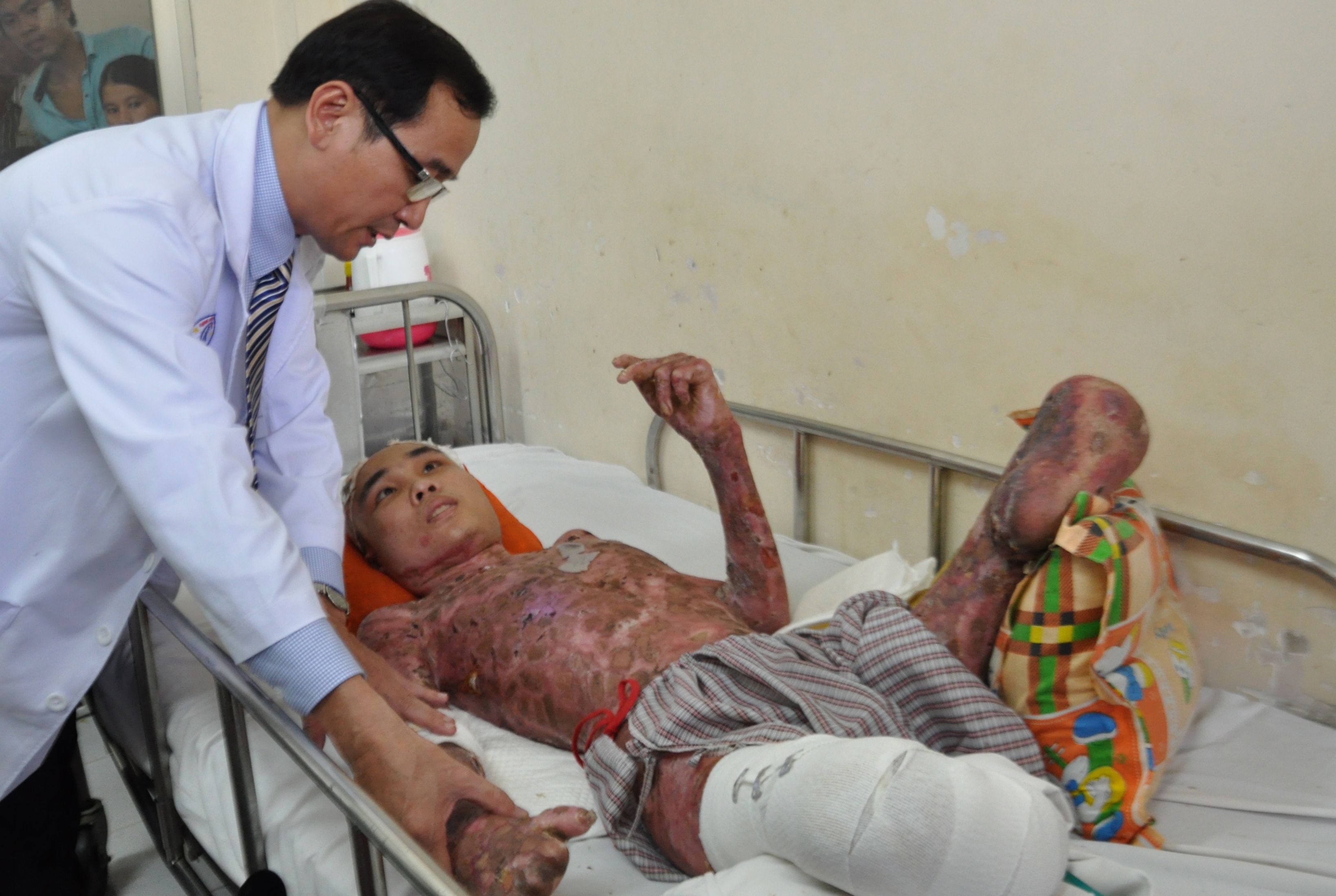 102 ngay gianh giat su song cho benh nhan bong xang hinh anh