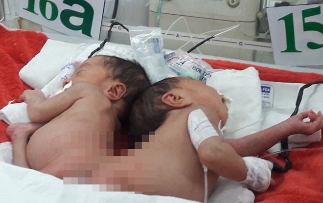 song sinh dính nhau ảnh 1 song sinh dinh nhau anh 1