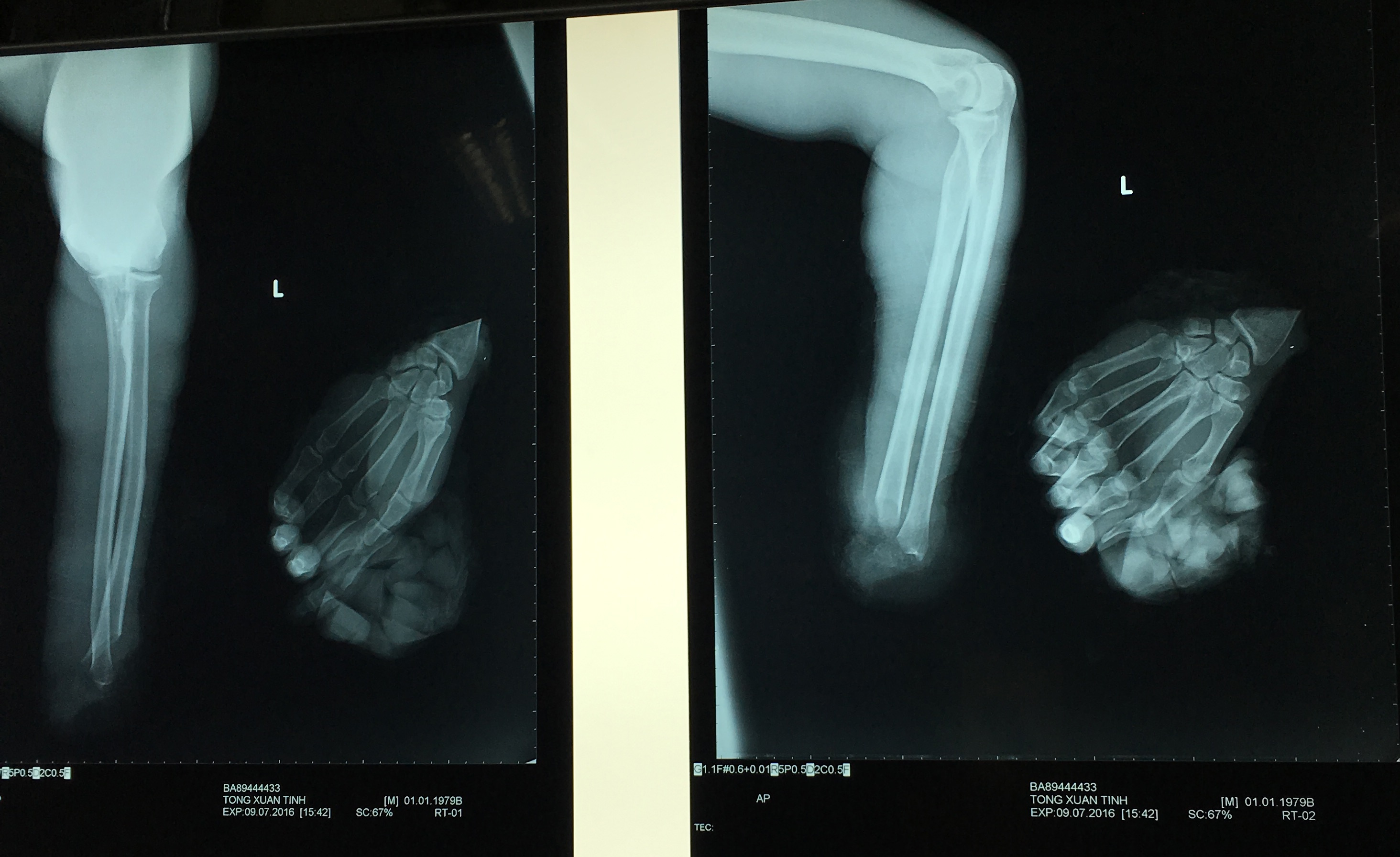 nối cánh tay đứt lìa ảnh 1 noi canh tay dut lia anh 1