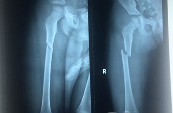 Bé trai bị cha dượng đánh gãy chân ảnh 2 Be trai bi cha duong danh gay chan anh 2