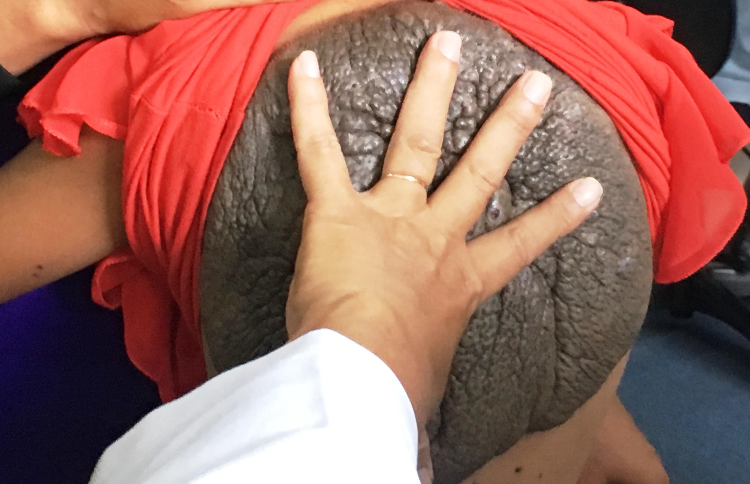 Bé gái có bướu mai rùa  ảnh 1 Be gai co buou mai rua anh 1