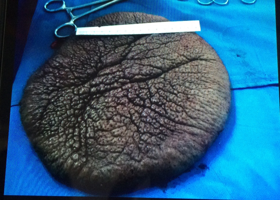 Tach thanh cong khoi buou ‘mai rua’ khoi lung be gai hinh anh