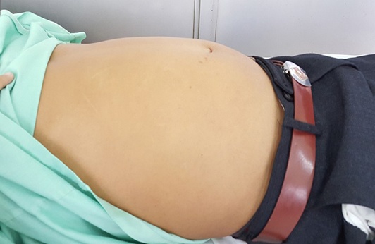 Boc tach khoi buou trong o bung nang 7 kg, chen ep noi tang hinh anh