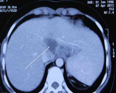 Chua khoi benh lao gan hiem gap tren the gioi cho nu sinh hinh anh