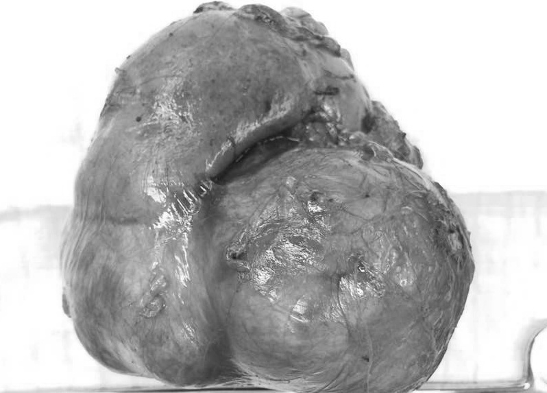 Ung thư thận ảnh 2 Ung thu than anh 2