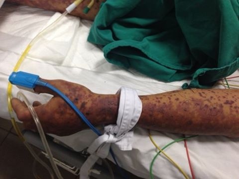 Giap Tet, nhieu nguoi bi nhiem lien cau khuan lon hinh anh