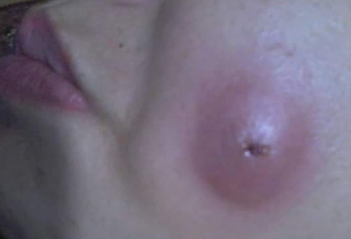 Nhiem trung sau khi cat ma lum dong tien hinh anh