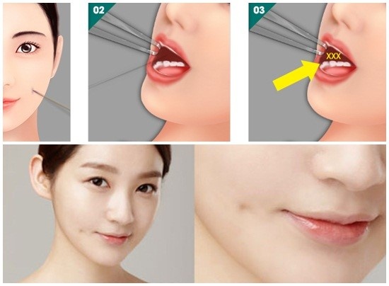 Nhiễm trùng do cắt má lúm ảnh 1 Nhiem trung do cat ma lum anh 1