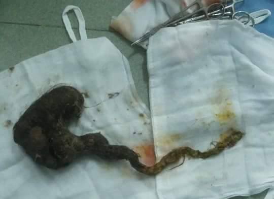 Lay bui toc ra khoi da day be gai 6 tuoi hinh anh