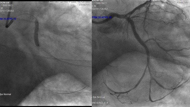 Du khách bị nhồi máu cơ tim ảnh 1 Du khach bi nhoi mau co tim anh 1