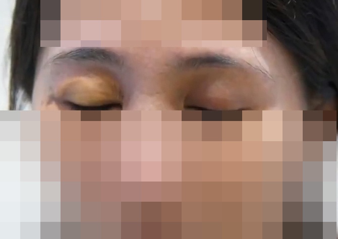 Suyt bi mu vi tiem silicon lam dep mat hinh anh