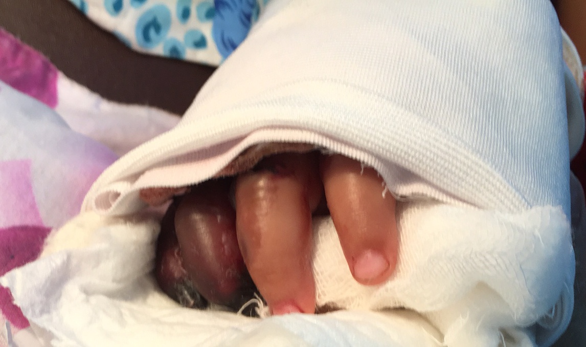 Be trai bi thang cuon o san bay Tan Son Nhat phai cat mot ngon tay hinh anh