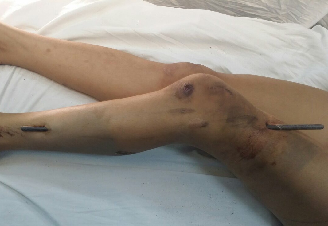 Tranh dong vat lieu ben duong, nu sinh bi que sat dam thau chan hinh anh