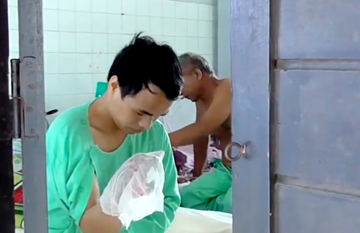 Noi dau cua cong nhan ngheo bi tai nan lao dong phai cat bo ban tay hinh anh