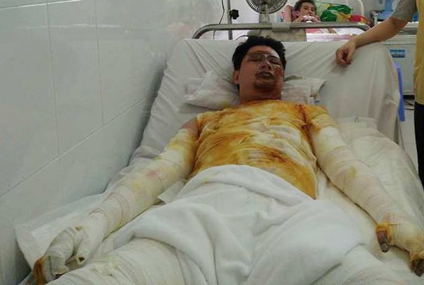 Nap binh xang xe moto 1.000 phan khoi bat tung, lai xe bong nang hinh anh