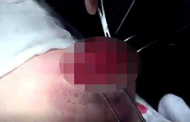 Hoai tu nguc do bom silicon anh 1