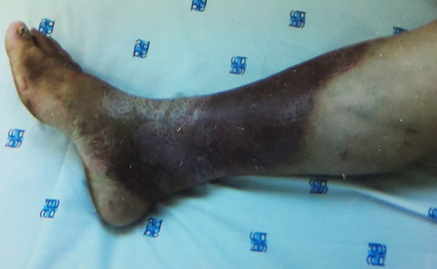 Can benh nguy hiem khien ban co the phai cat chan hinh anh