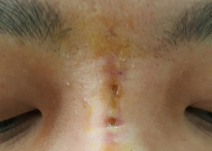 Gap gan 30 soi chi cho benh nhan sau khi nang mui bi hoai tu hinh anh