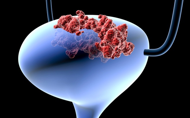 Dung ruot non tai tao bang quang cho benh nhan ung thu hinh anh