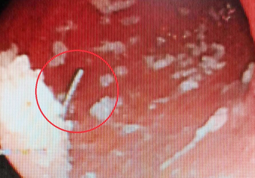 Gap cay kim dai 2,5 cm trong bung nam cong nhan hinh anh