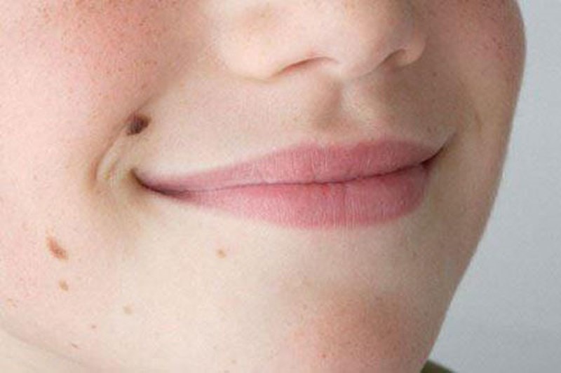 Co gai phat hien benh hiem nho not sac to dam mau tren mat hinh anh