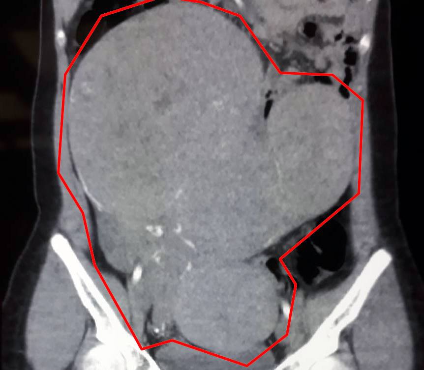 Co gai bi khoi u khung anh 1