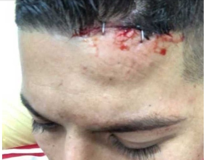 Nguy cơ Bailly nghỉ hết mùa,  Rojo dính chấn thương ghê rợn ảnh 2 Nguy co Bailly nghi het mua,  Rojo dinh chan thuong ghe ron anh 2