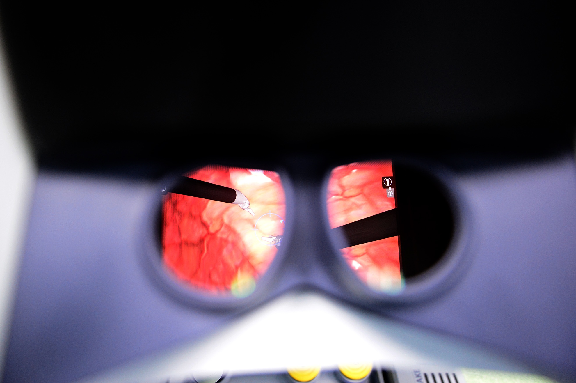 robot phau thuat cho nguoi lon dau tien o Viet Nam anh 7