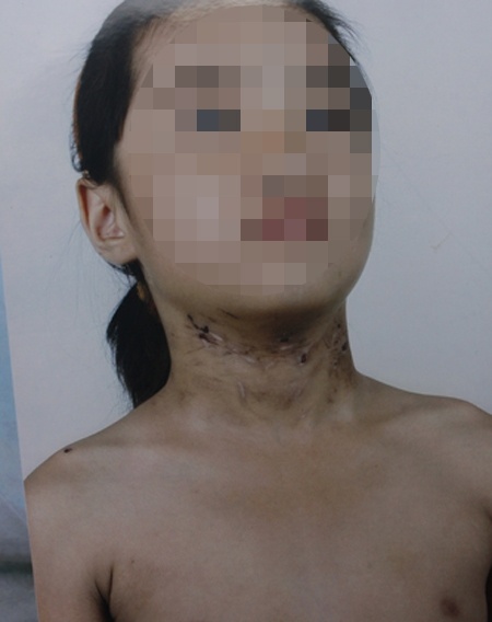 Be gai bi danh gay xuong suon, vut ra ngoai nghia dia hinh anh