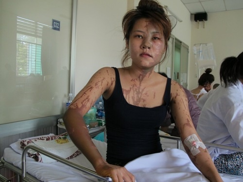 Nu le tan nha hang bi tat axit giua dem hinh anh