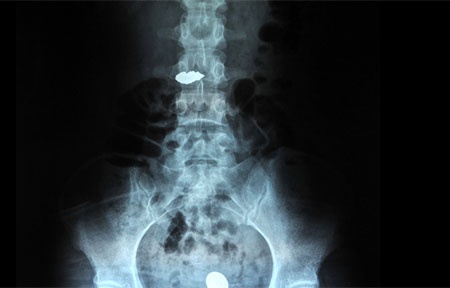 Ten trom nuot nhan, vong deo tai vang vao bung hinh anh