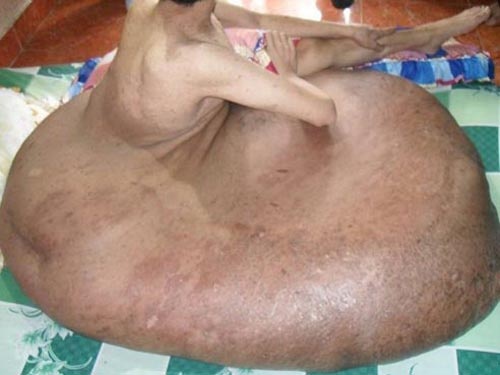 Anh Hai 'chan voi' tu vong do tac nghen mach phoi hinh anh