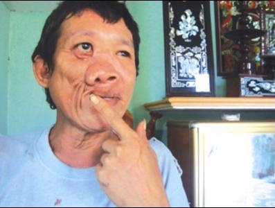 Ca mo 11 tieng cho nguoi dan ong mang khuon mat cua 'quy' hinh anh