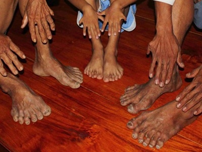 Gia toc co 14 nguoi chan tay 6 ngon o Ben Tre hinh anh