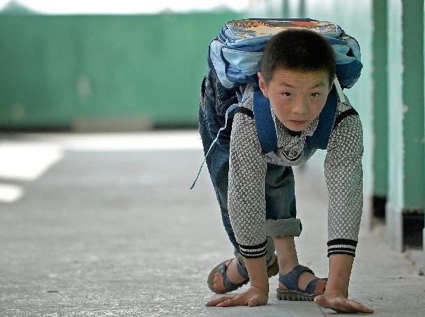 Nghi luc chien dau benh tat cua 'cau be oc sen' bo den lop hinh anh