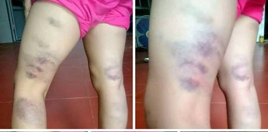 cô giáo đánh tím chân học sinh  ảnh 1 co giao danh tim chan hoc sinh anh 1