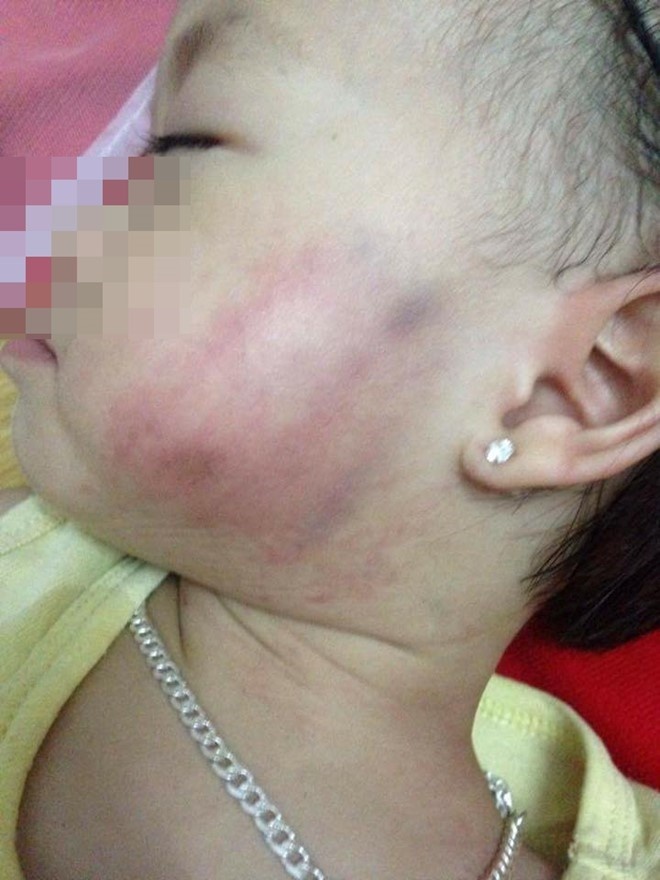 giáo viên tát bé gái bầm má ảnh 1 giao vien tat be gai bam ma anh 1