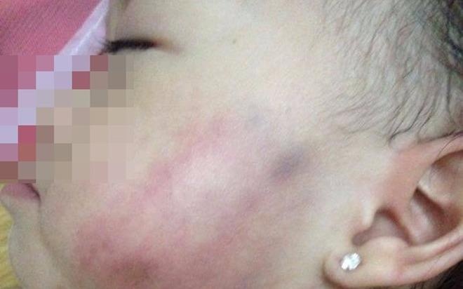 Vet bam tren mat tre 16 thang va luong tam nguoi lon hinh anh