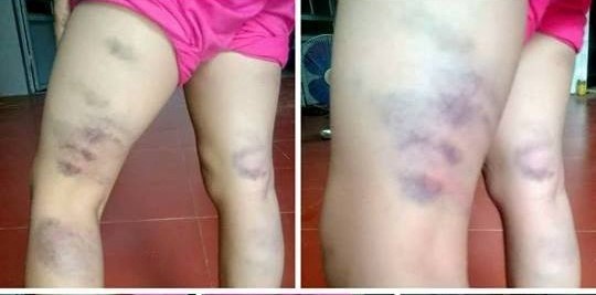 giáo viên tát bé gái bầm má ảnh 2 giao vien tat be gai bam ma anh 2