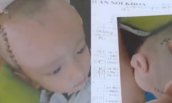 Cong an dieu tra vu be 3 tuoi bi chan thuong so nao hinh anh