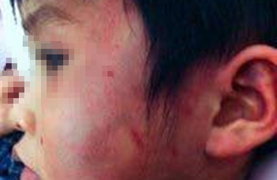 Be 4 tuoi bi danh bam nguoi: Ky luat hieu truong va giao vien hinh anh