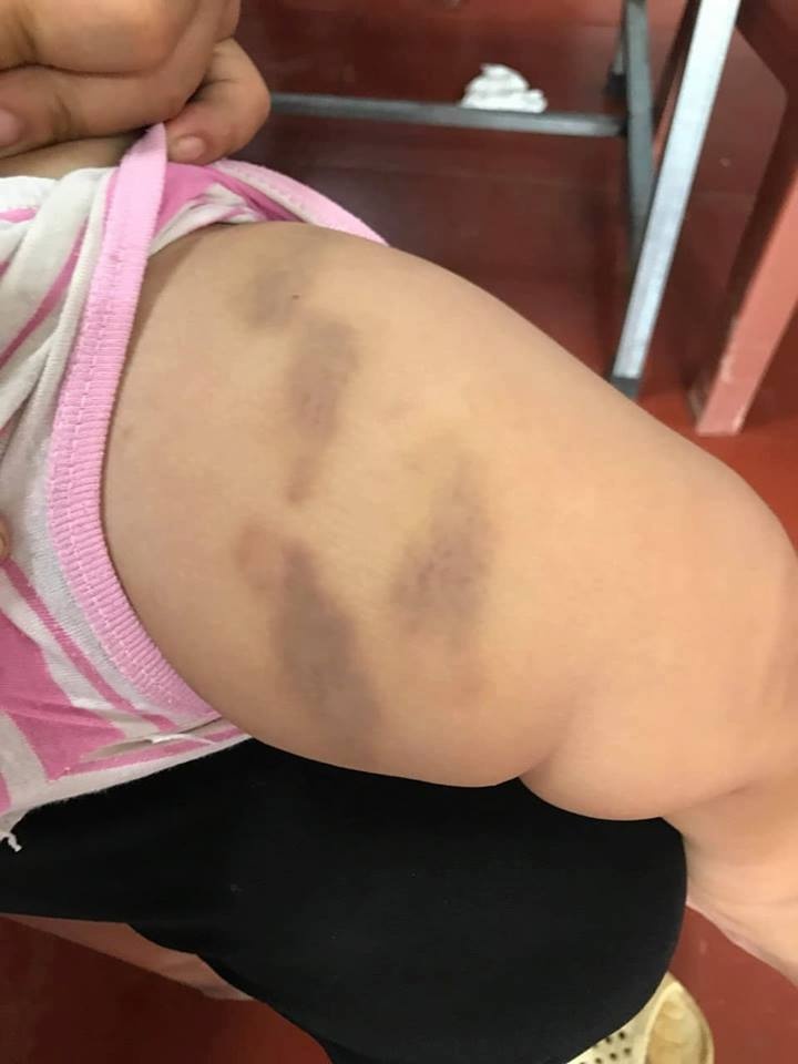 tre bi can khap mat anh 2