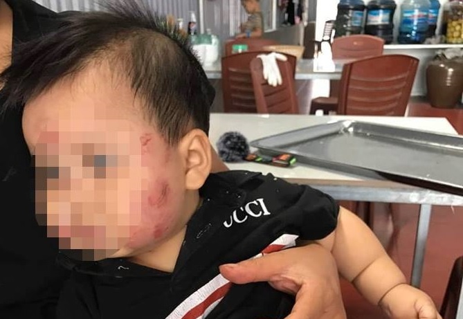 Phu huynh to tre 11 thang tuoi bi can khap mat hinh anh