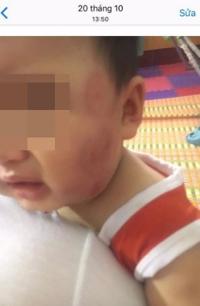 be 11 thang tuoi bi can khap mat anh 1