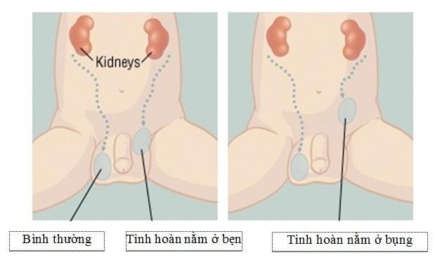 Tinh hoàn ẩn ảnh 1 Tinh hoan an anh 1