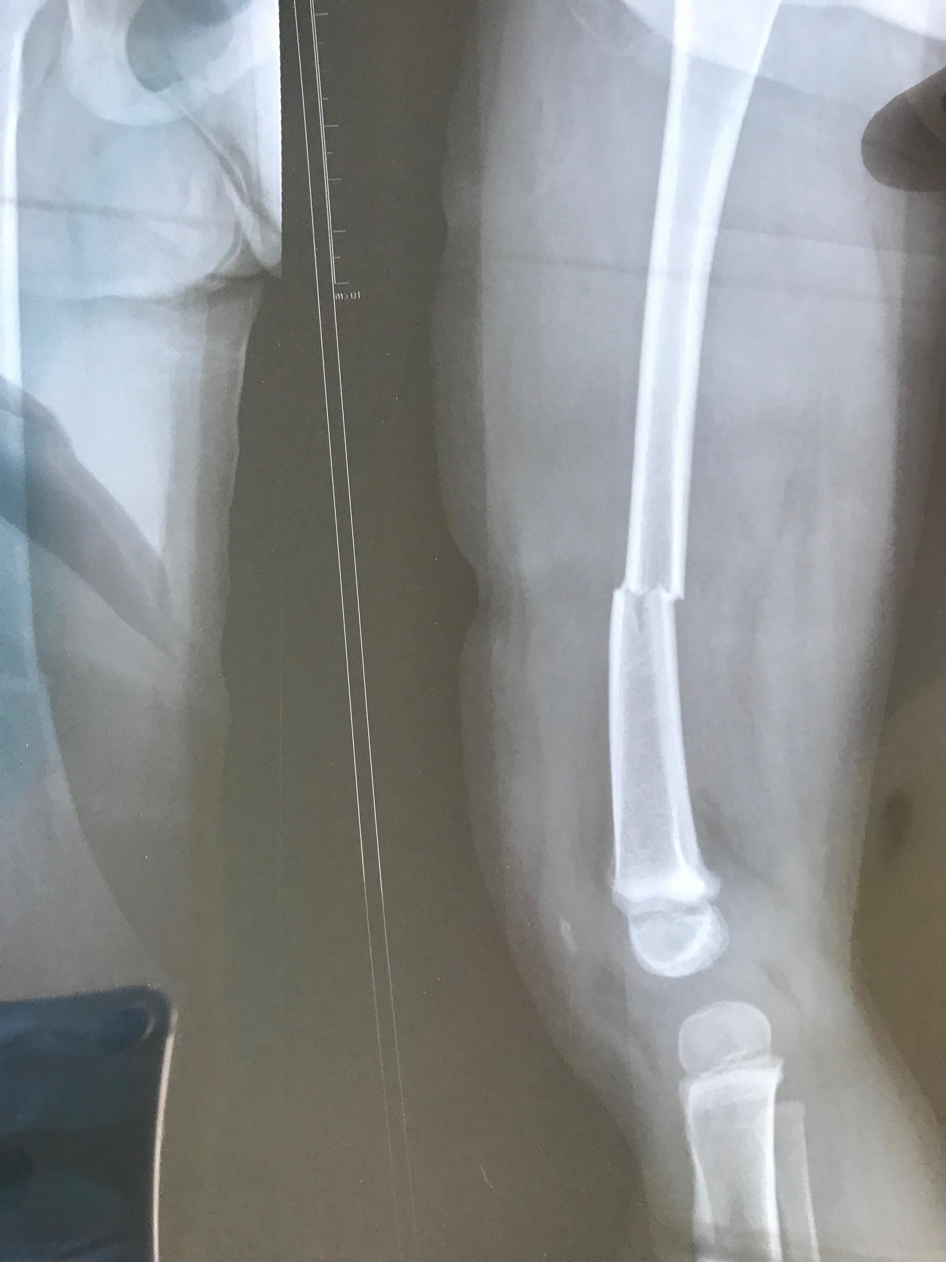 hoc sinh bi gay xuong dui anh 1